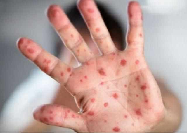 На Полтавщині за тиждень 9 людей захворіли на кір