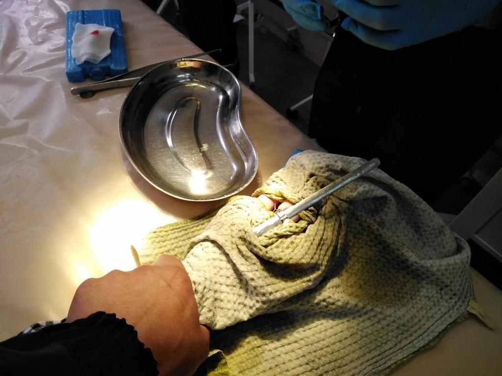 13-річна кременчужанка не могла зняти каблучку – рятувальники пиляли «болгаркою». ВІДЕО