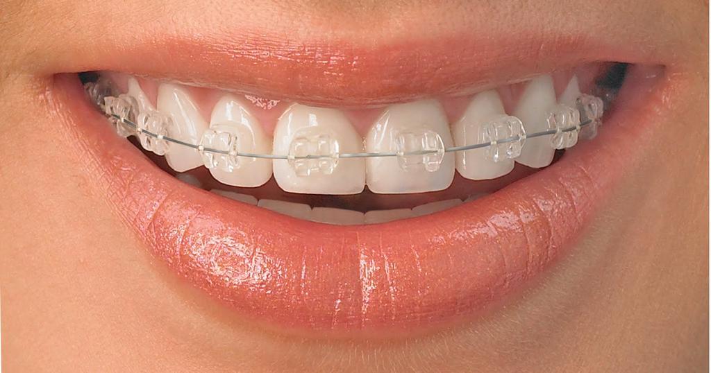 Керамічні брекети: ефективне відновлення зубів без дискомфорту