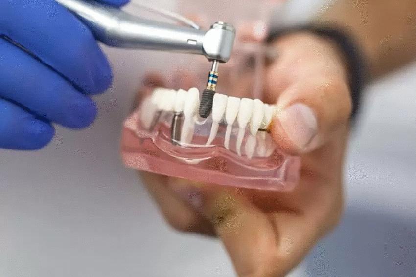 Відторгнення зубного імпланту: симптоми та причини