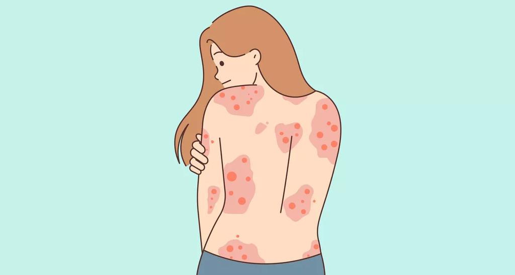 Псоріаз: міфи і правда про хворобу