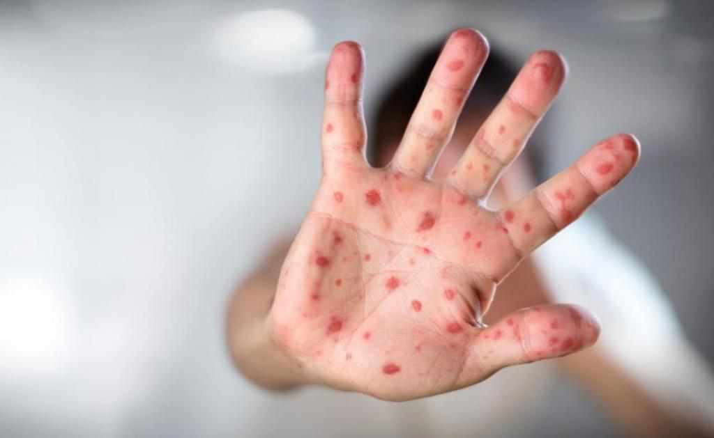 Кір у Миргороді: хворих виявляють щодня